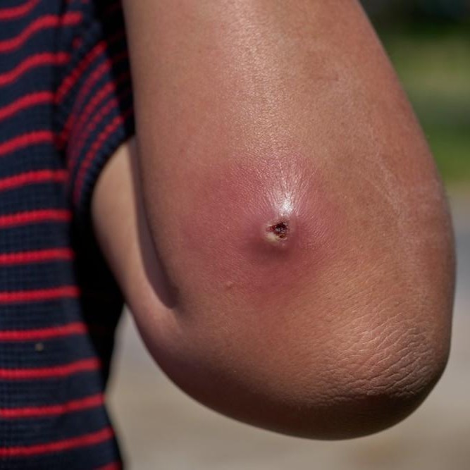 Abscess Drainage Service